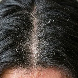 Descamación por sequedad