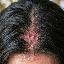 Foliculitis Capilar