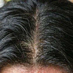 Seborrea ( Grasa Excesiva)