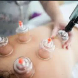 Acupuntura al vacío con Ventosas  