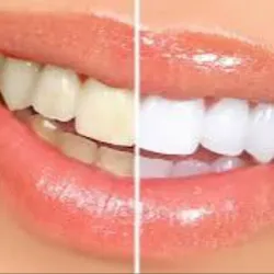 Blanquemiento Dental 