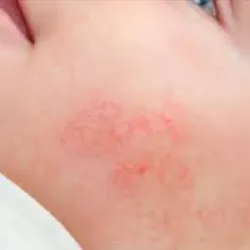 Dermatitis. Acné o Alopecia 