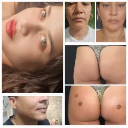 Filler de acido hialurónico 