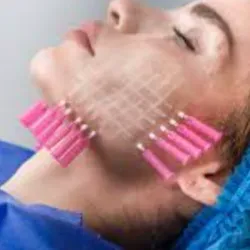 Hilos de polidoxanona ( Pdo)