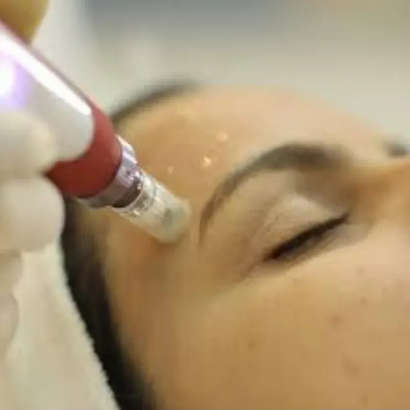   Microneedling o Dermapen