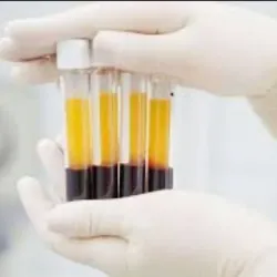 Plasma Rico en fibrina ( PRF)