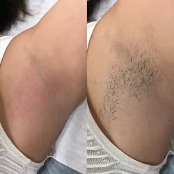 Depilación de  Axilas