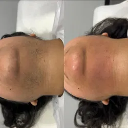 Depilación de Barbilla