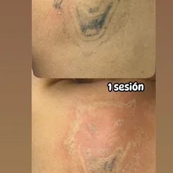 Eliminación Láser de Micropigmentación