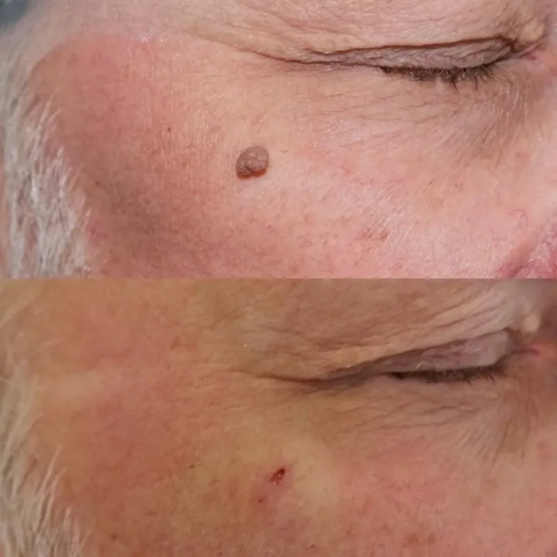 Fibroblast ( Plasma Pen ) Quema de verrugas o acrocorones