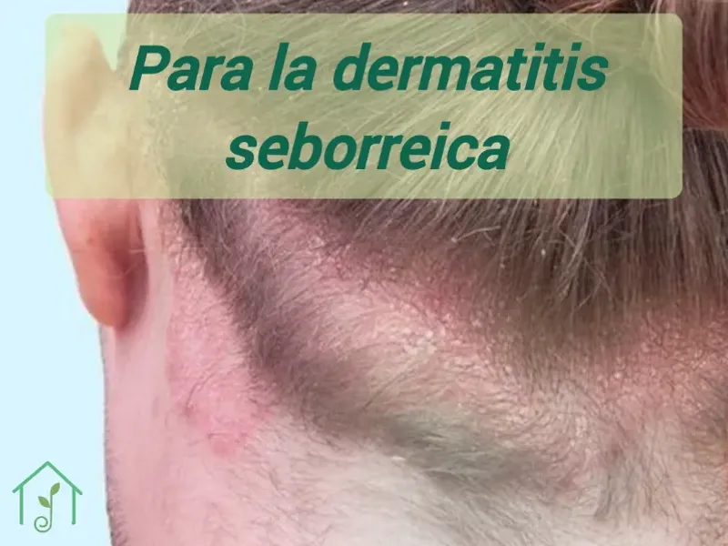 Para la dermatitis seboréica