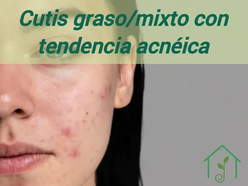 Cutis graso/mixto con tendencia acnéica