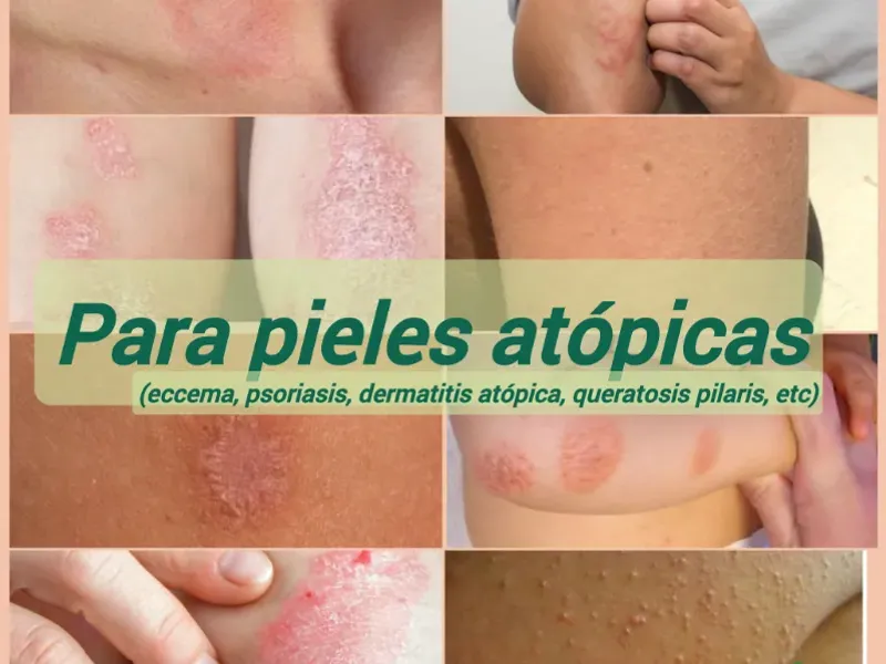 Para pieles atópicas (psoriasis, dermatitis, eccema, queratosis pilaris)