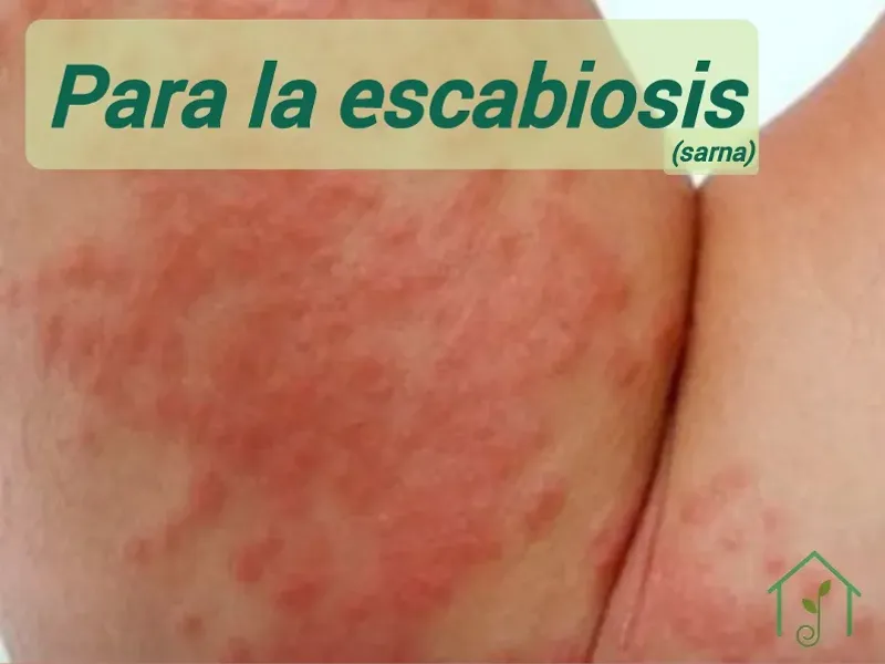 Para la escabiosis