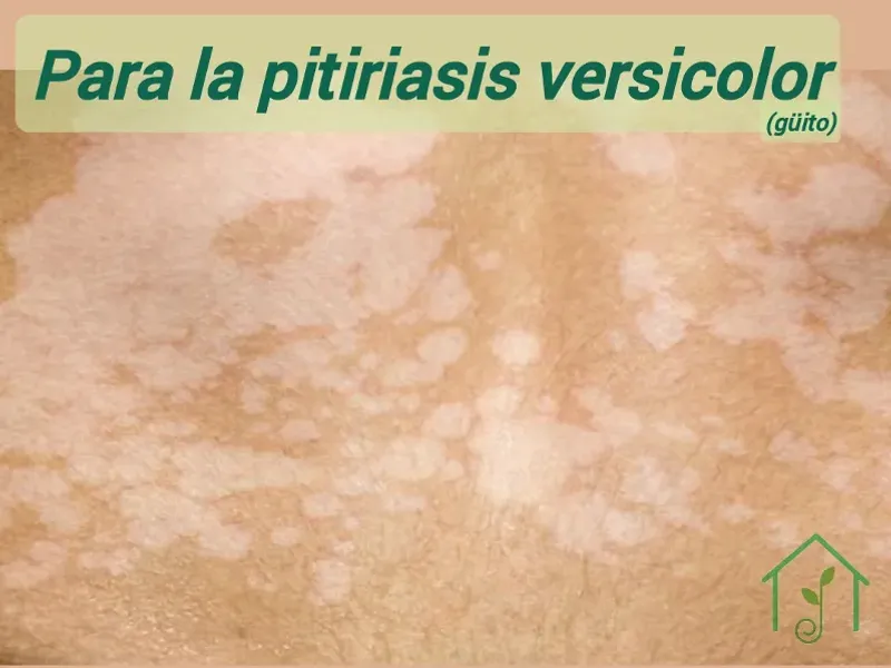 Para la pitiriasis versicolor (güito)