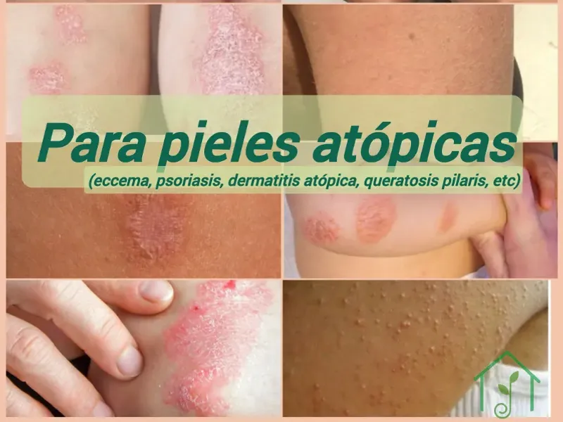 Para pieles atópicas (psoriasis, dermatitis, eccema, queratosis pilaris)