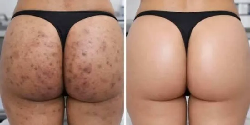 Limpieza de Glúteos (Foliculitis)