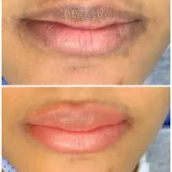 Neutralizacion  de labios 