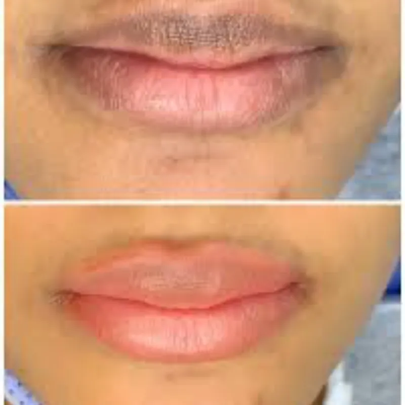 Neutralizacion  de labios 