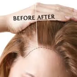 Tratamiento para Alopesia