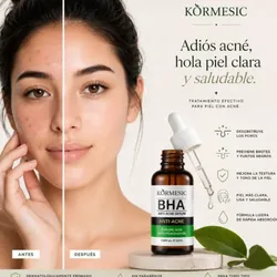 serum anti acné 💚