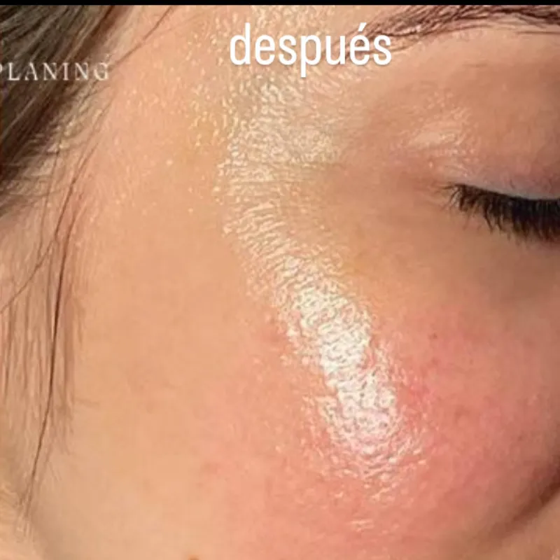 Dermaplaning