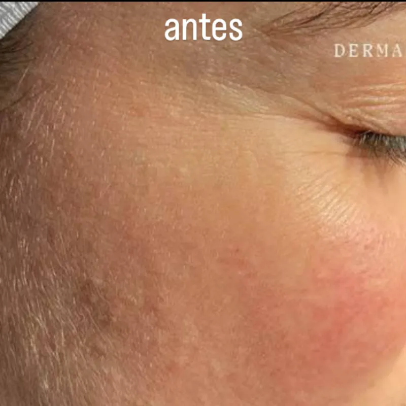 Dermaplaning