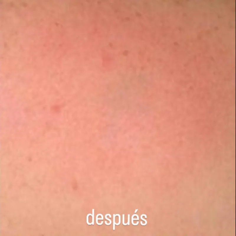 Láser picosecond azul Neatcell: despidete de las imperfecciones 