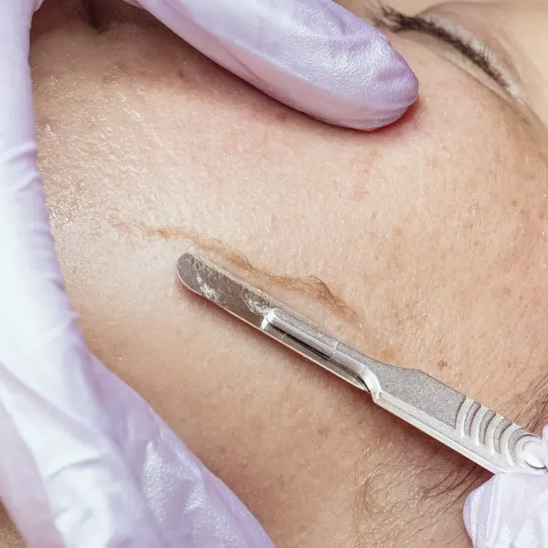 Dermaplaning