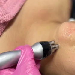 Radiofrecuencia cara cuello y escote