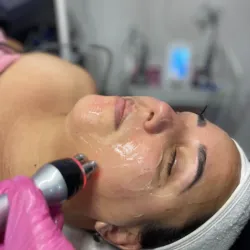 Radiofrecuencia facial