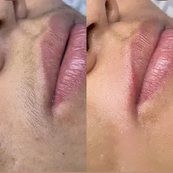 Depilación de bigote 