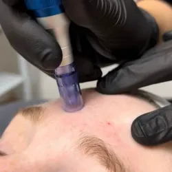 Microneedling ( dermapen)