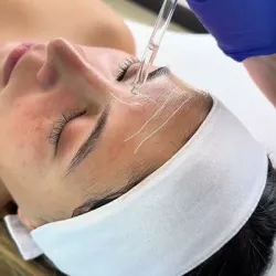 Tratamiento con hilos de colageno