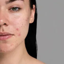 🌸Tratamiento para pieles con brotes de acné  