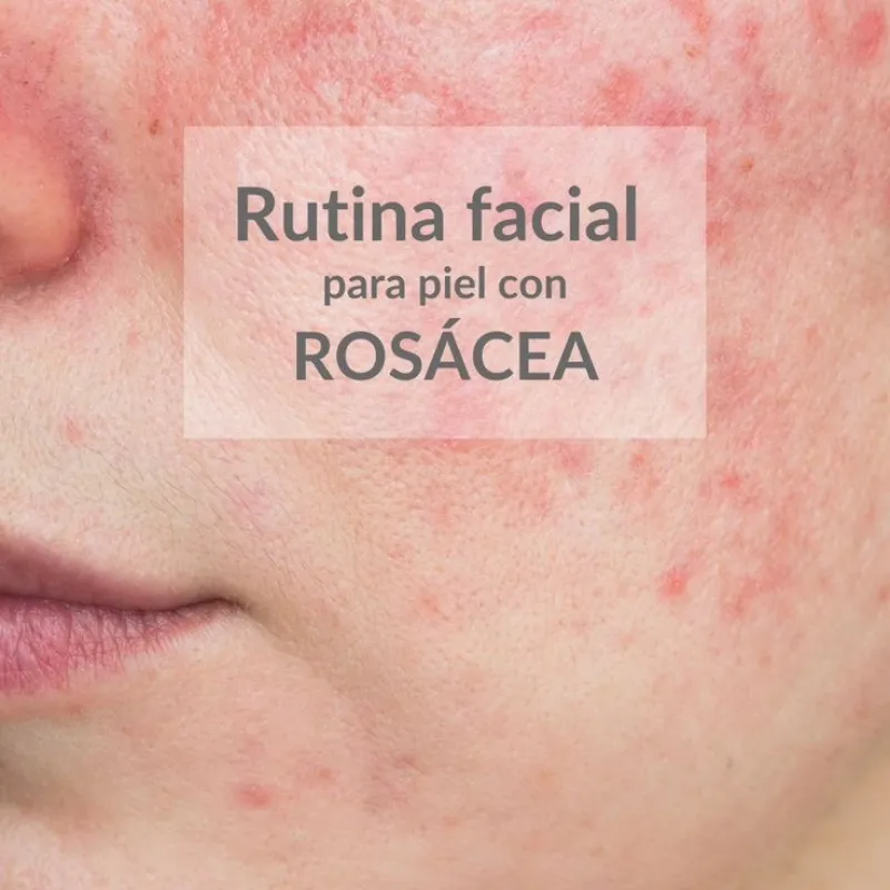 🍒Tratamientos para pieles con rosácea 