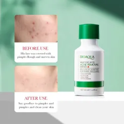 Serum con Ácido Salicílico de Bioaqua 