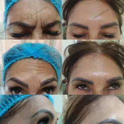 Botox Facial