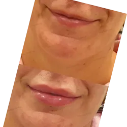 Rellenos faciales