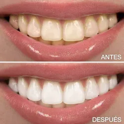 Blanqueamiento Dental 