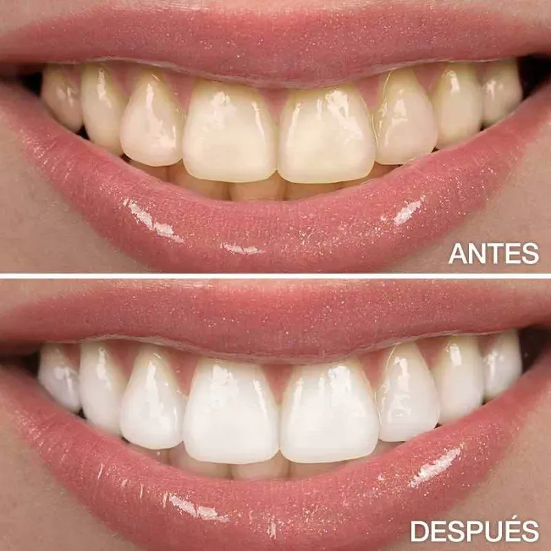 Blanqueamiento Dental 