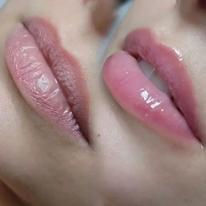 Hydralips
