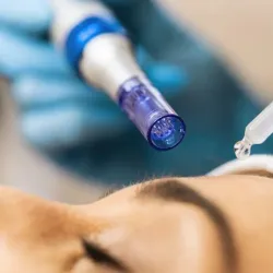 Microneedling 