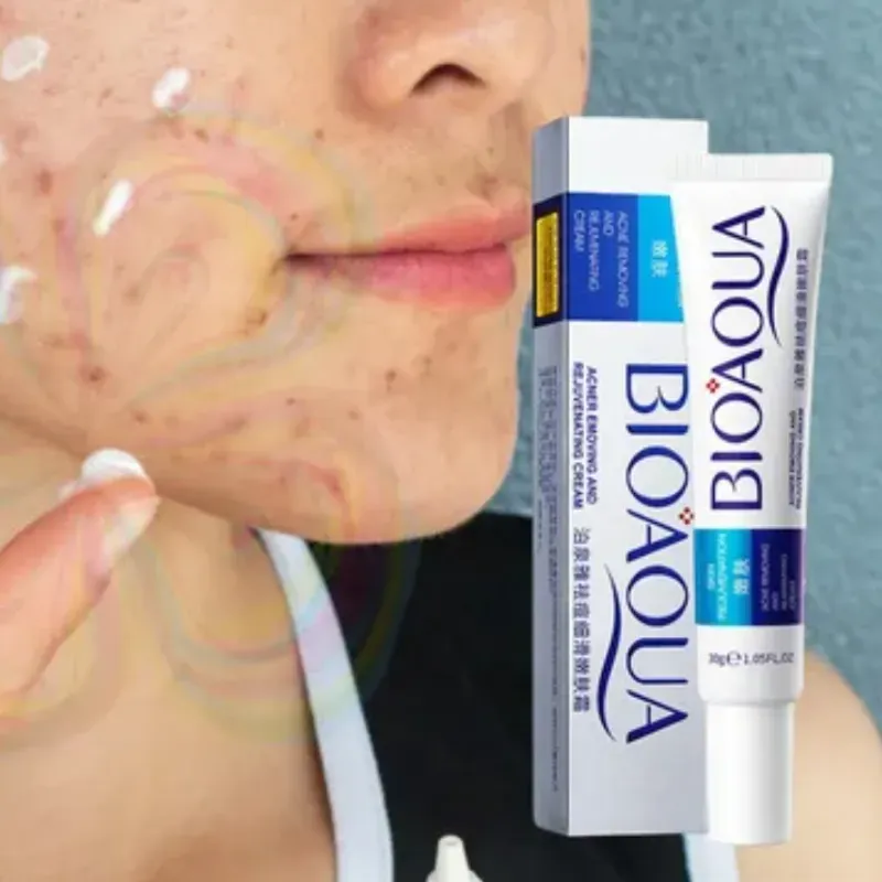 Crema antiacné