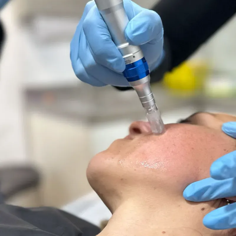 Dermapen o microneedling