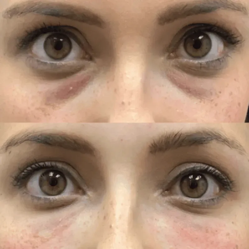Dermapen o microneedling