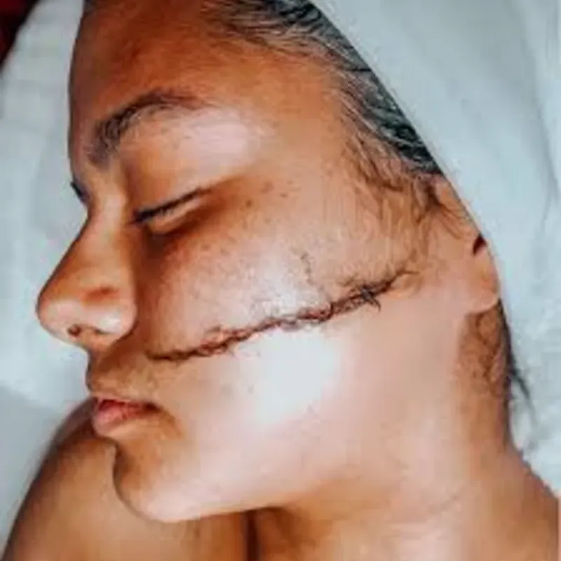 Dermaplaning