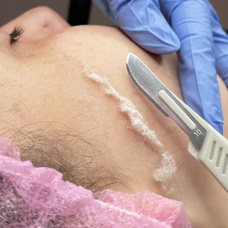 Dermaplaning