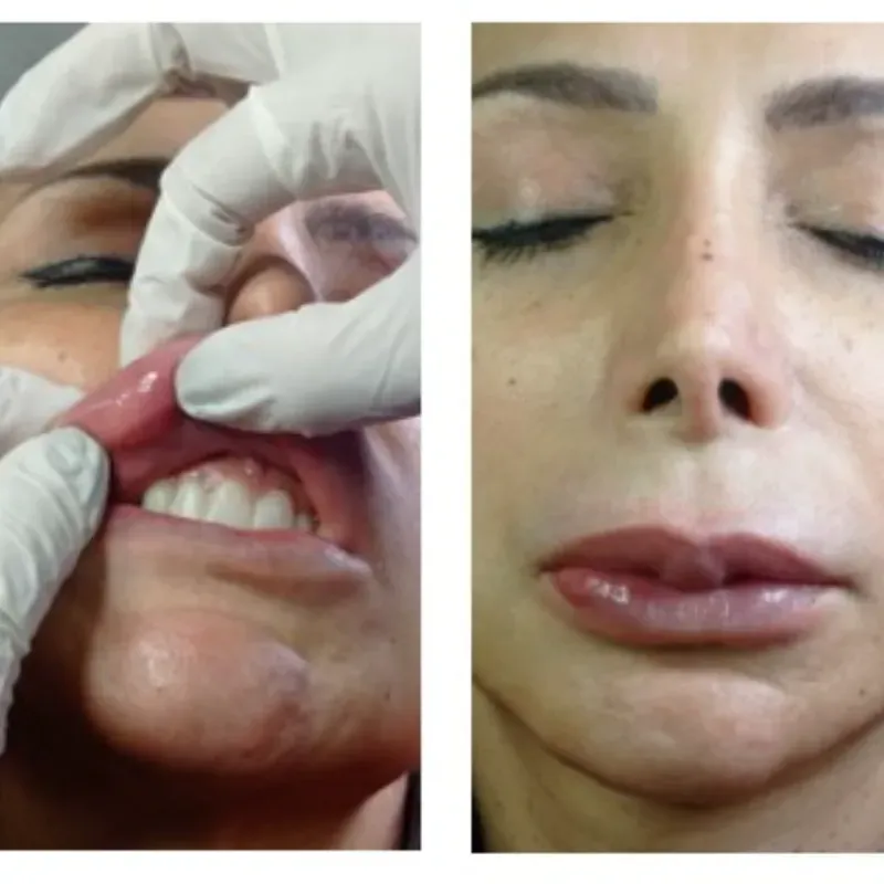 Eliminación de relleno labial indeseado.