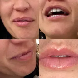 Eliminación de relleno labial indeseado.